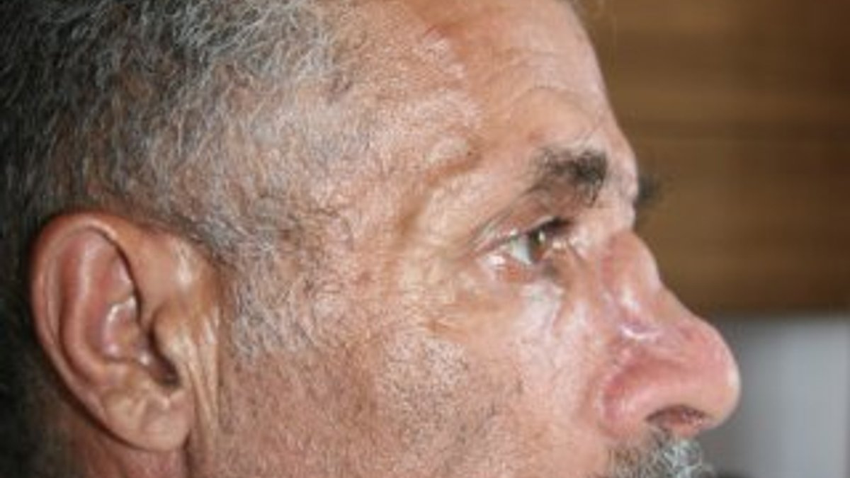 Yemenli hastaya kaburgasından burun yapıldı