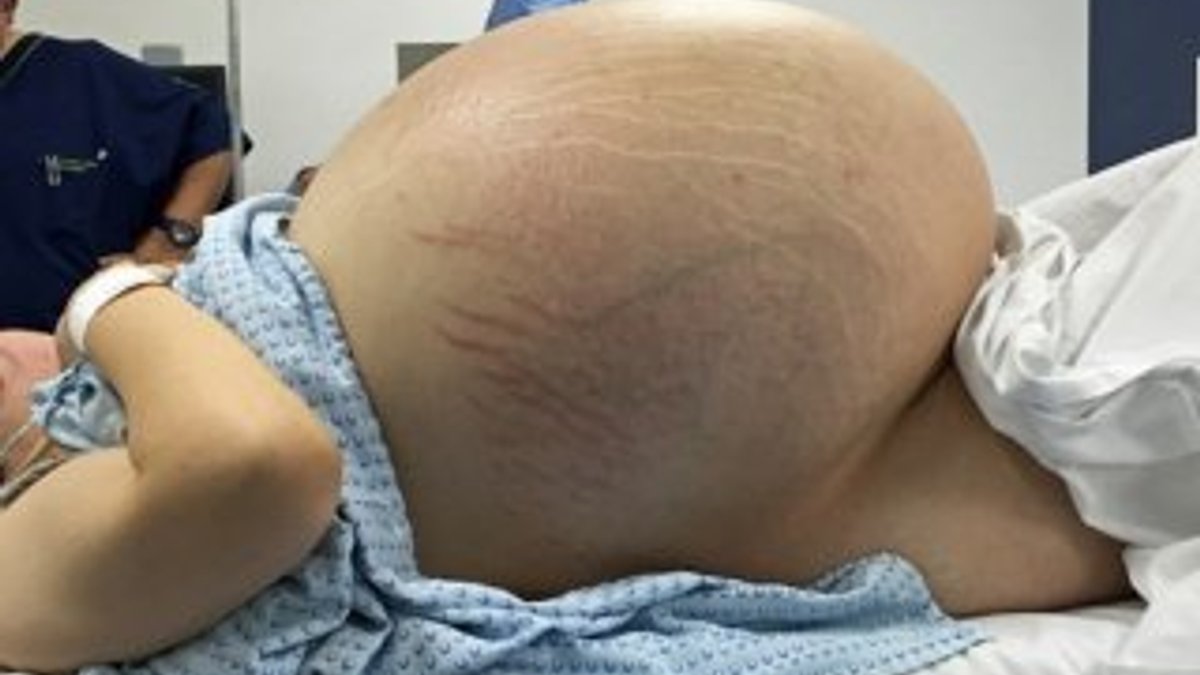Over kisti olan Meksikalı kadın ameliyat edildi