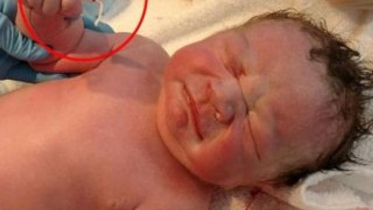 ABD'de bir bebek, elinde spiralle doğdu