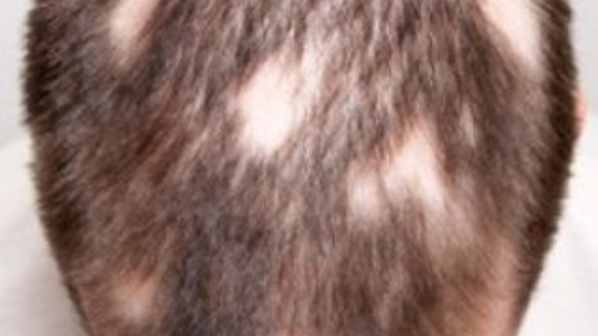 Alopesi areata nedir