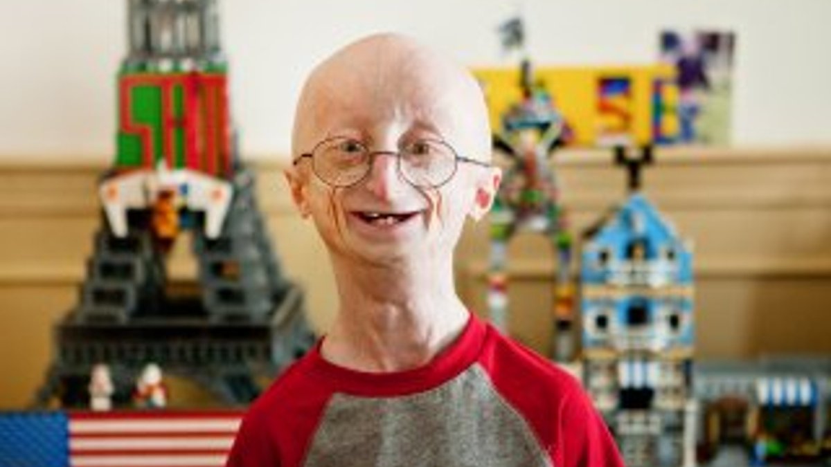 Progeria nedir