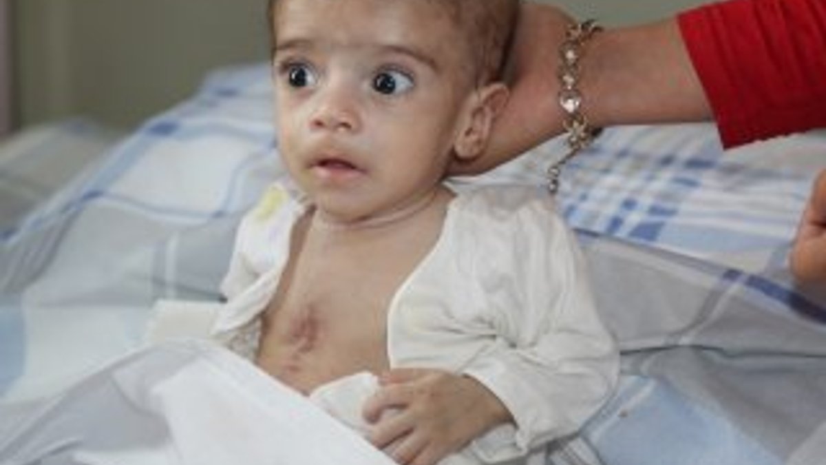 4 aylık bebeğin kalp damarları değiştirildi