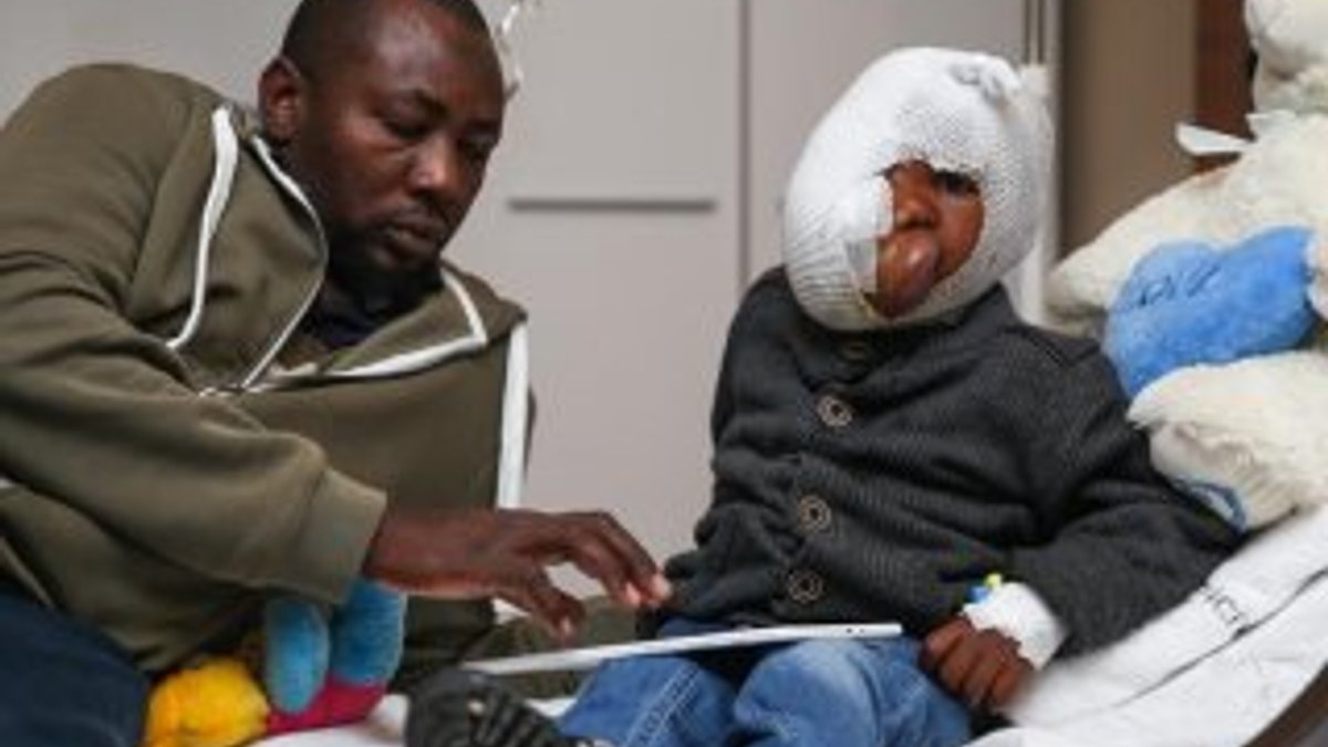 Yüzünün yarısını kaplayan tümörden Türkiye'de kurtulacak
