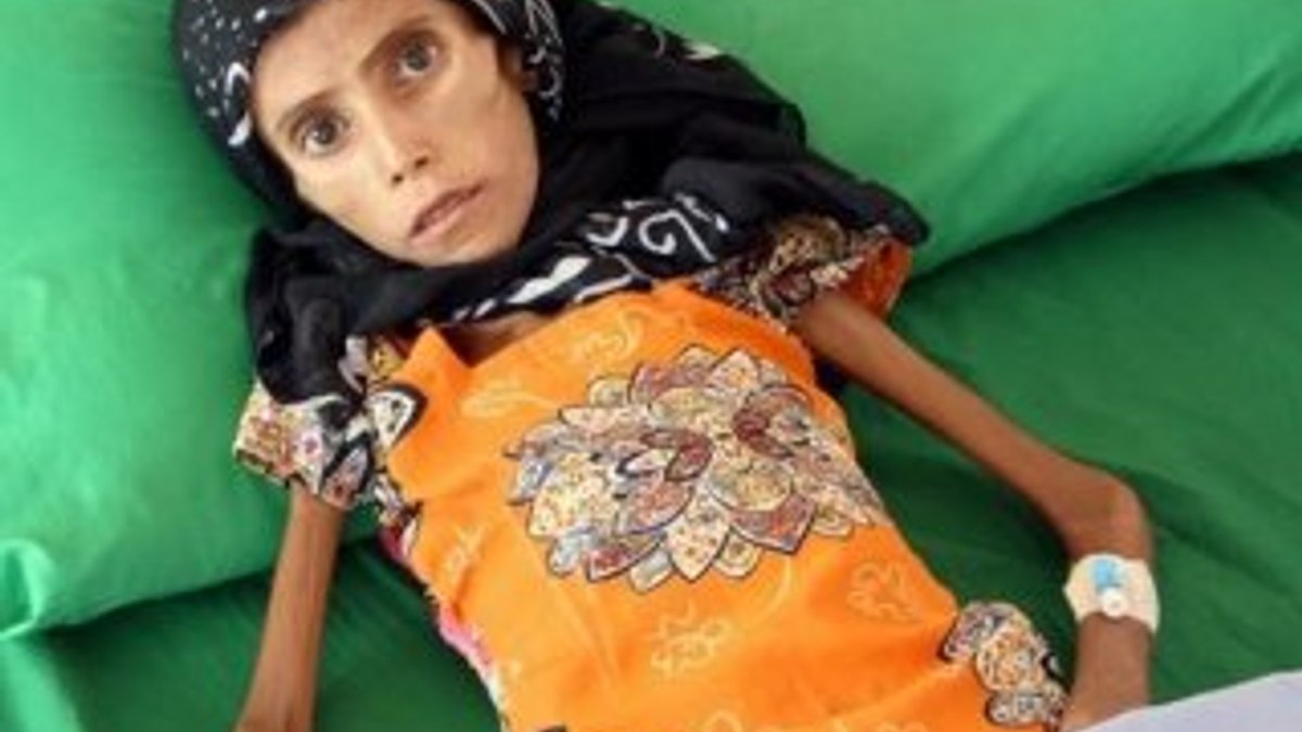 Yemenli kız bir deri bir kemik kaldı
