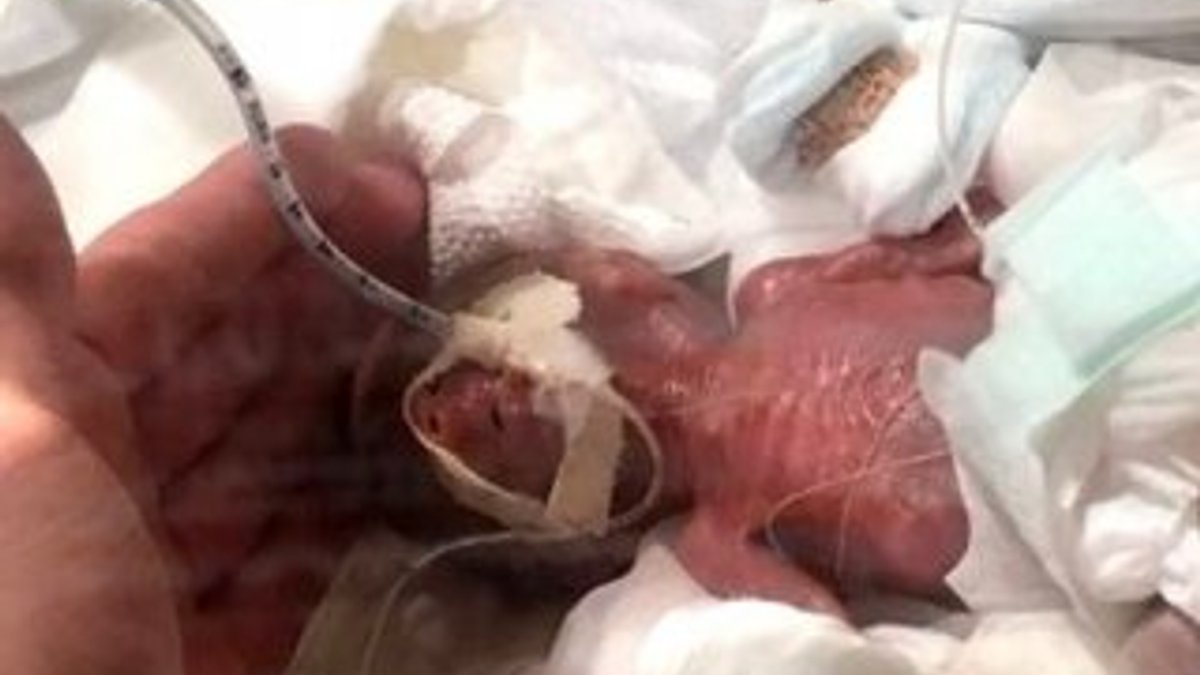 Japonya'da 268 gram doğan bebek taburcu edildi