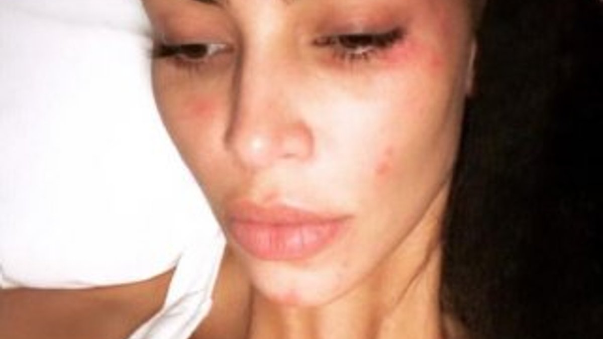 Kim Kardashian sedef hastası