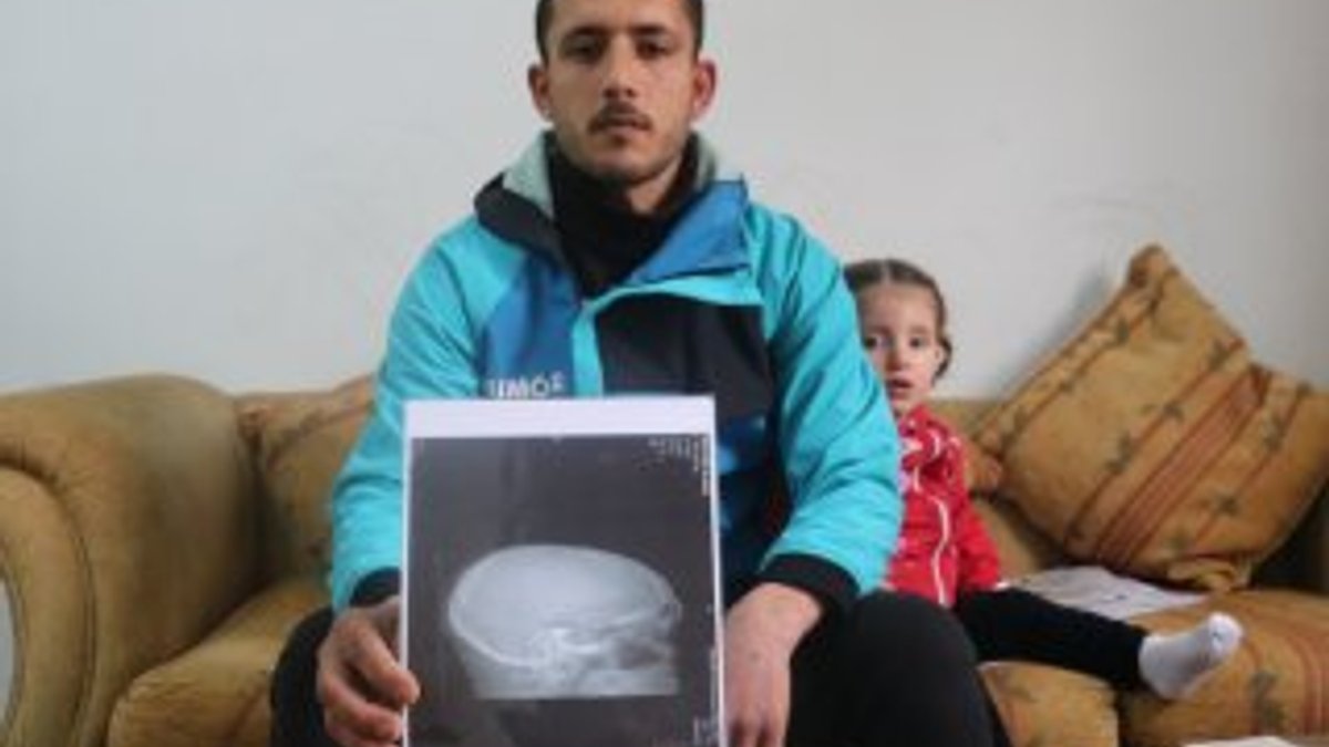 Suriye’deki savaş mağduru kafasındaki mermiyle yaşıyor
