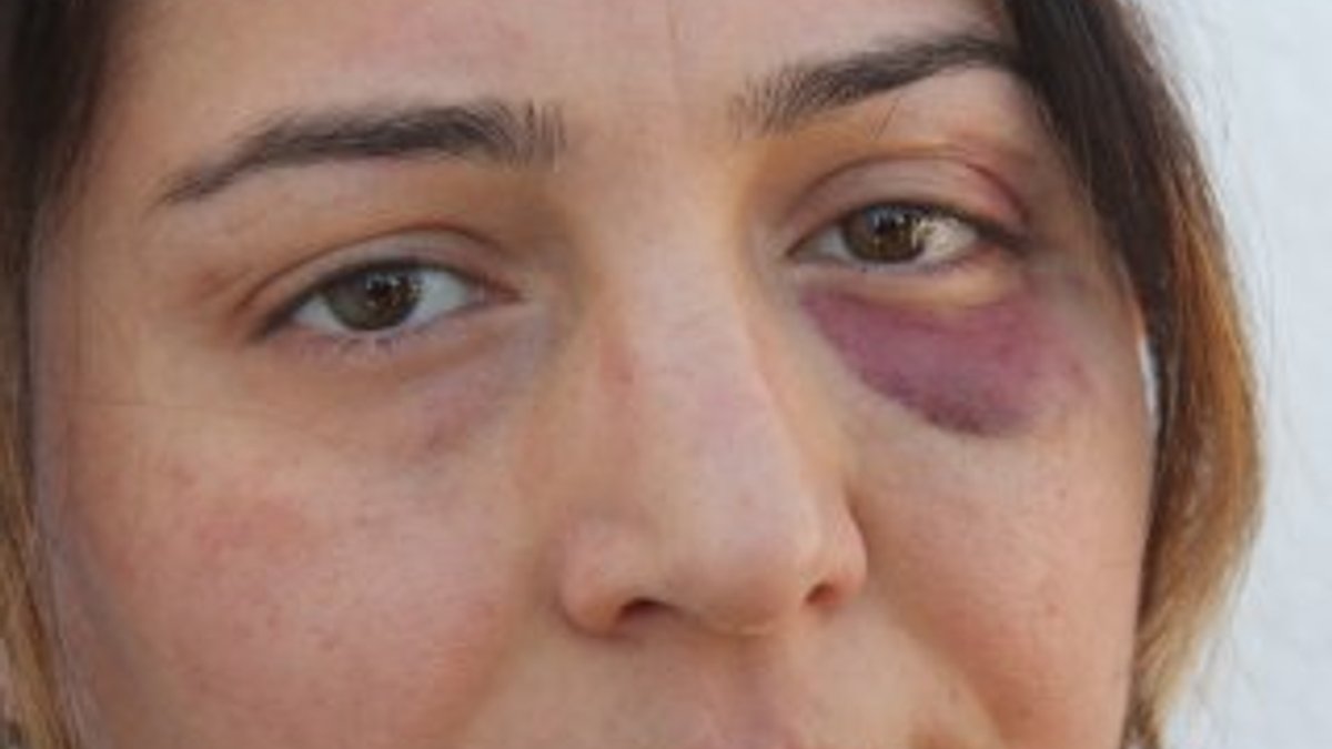 Adana'da yaralıya müdahale eden hemşireye saldırdılar