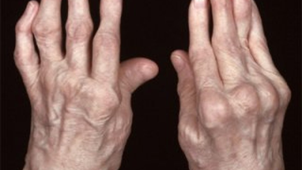 Romatoid artrit nedir
