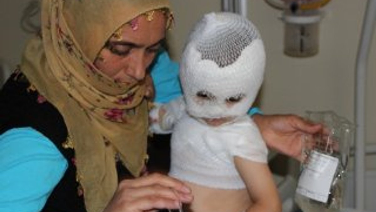 Erzurum'da 2 yaşındaki çocuğun üzerine kaynar su döküldü