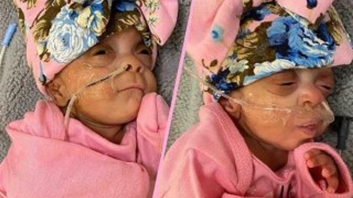 ABD'li doktorların 'doğmaları mucize' dediği ikizler