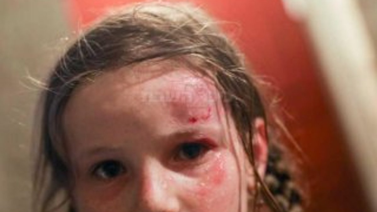 İsrail'de 10 yaşındaki kız çocuğu bombadan yaralandı
