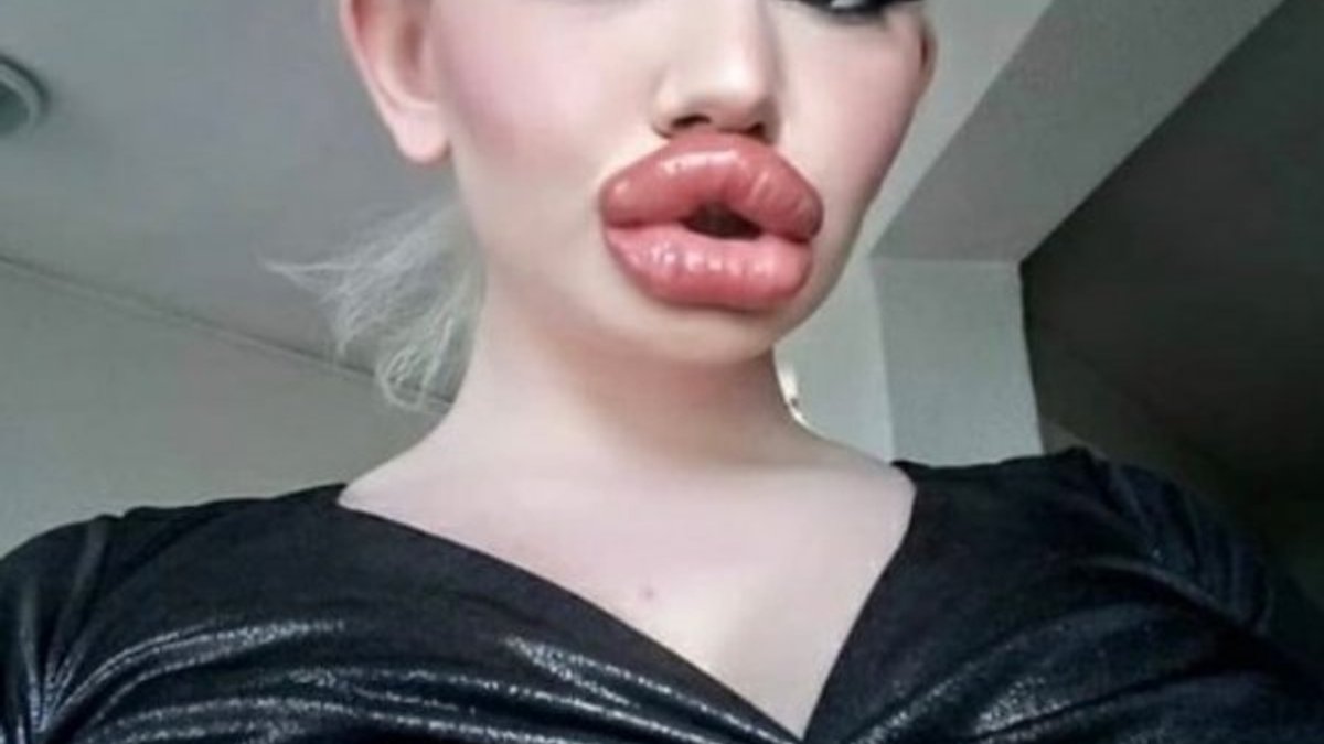 Bulgaristan'da genç kız, 20'den fazla dudak dolgusu yaptırdı