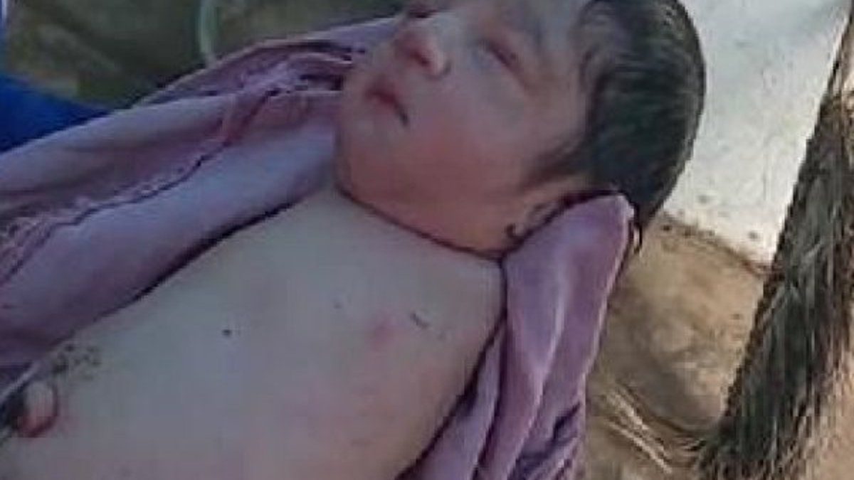 Hindistan’da kolları ve bacakları olmadan doğan bebek