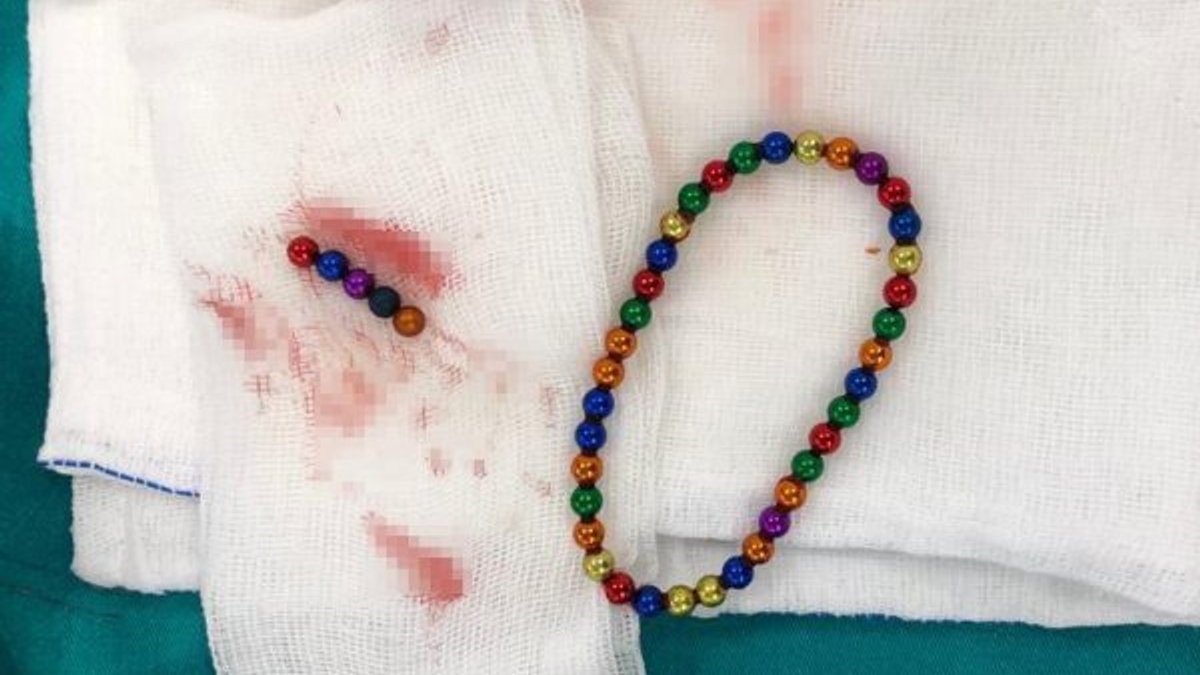 9 yaşındaki çocuğun midesinden mıknatıs topları çıkarıldı