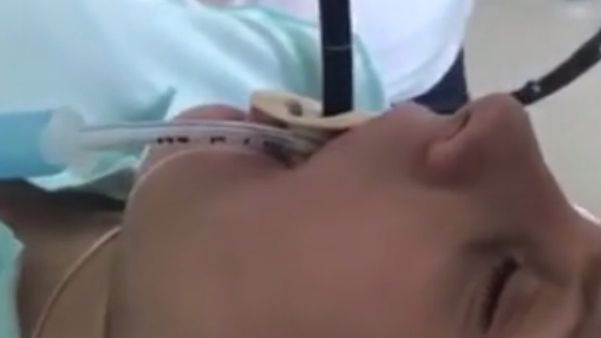 Rusya'da uyuyan kadının ağzından giren yılan ameliyatla çıkarıldı