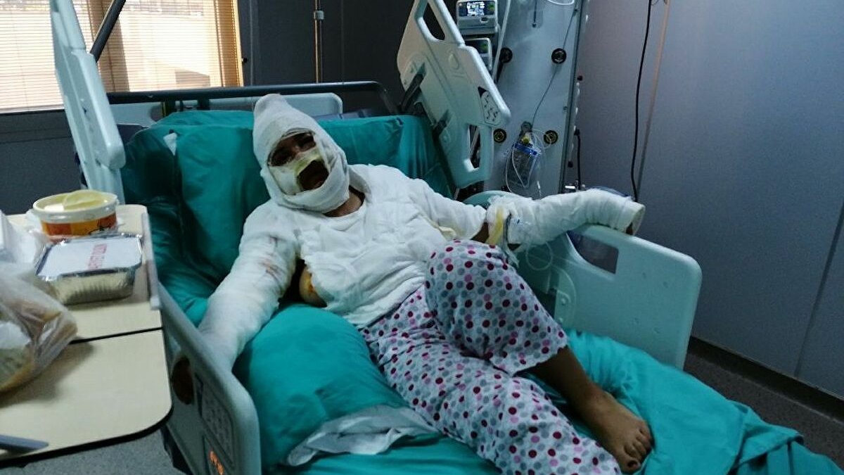 İstanbul'da yüzüne kızgın yağ attığı erkek arkadaşı ceza aldı, kadının tepkisi pes dedirtti