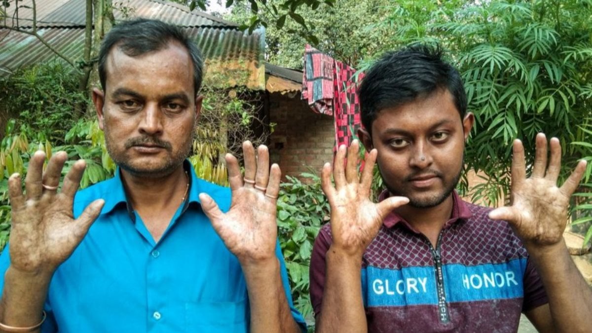 Bangladeş’teki bir ailede, erkeklerin parmak izi yok