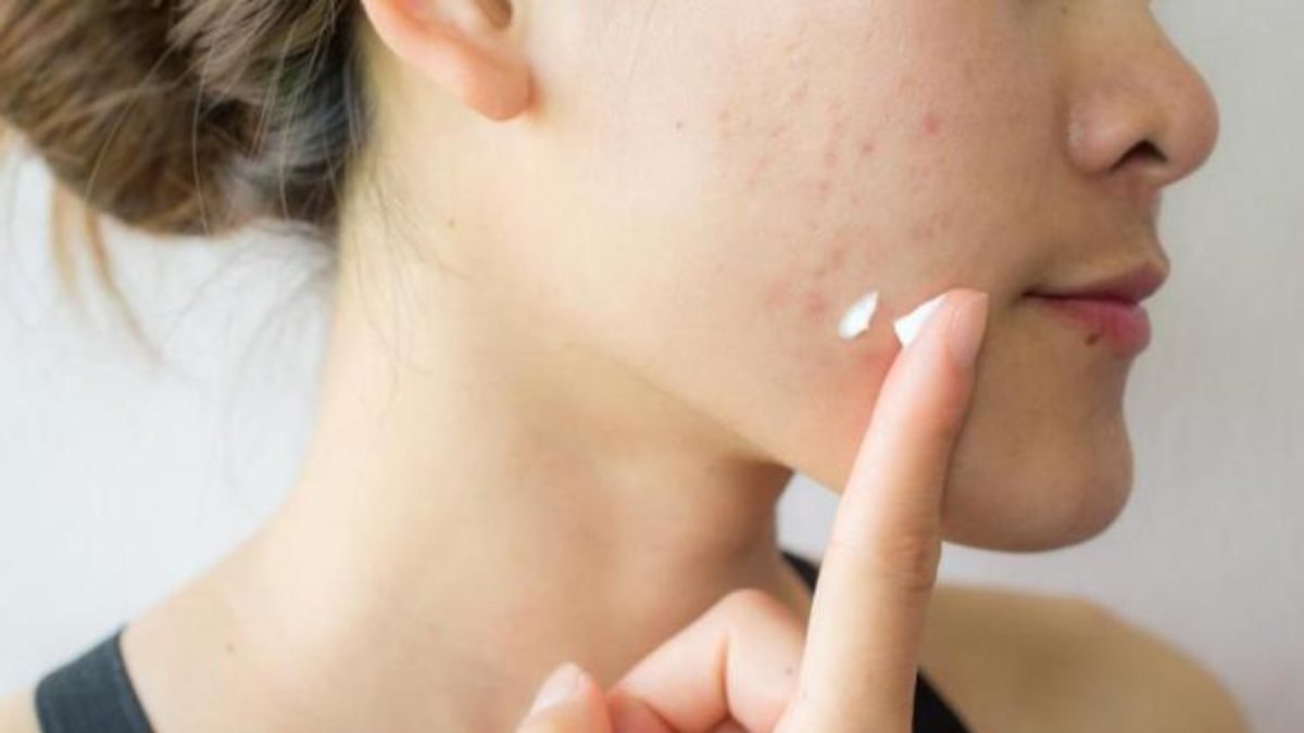 Roaccutane nedir? Sivilceler için Roaccutane nasıl kullanılır? Roaccutane yan etkileri nelerdir?