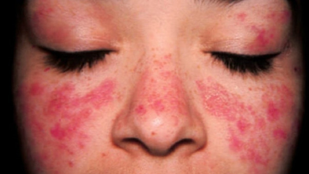 Lupus (kelebek hastalığı) nedir, belirtileri nelerdir? Lupus hastalığı tedavisi var mı?