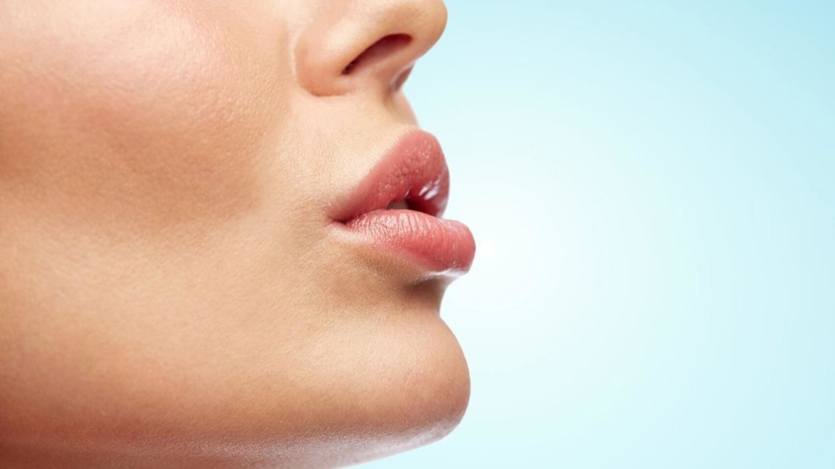 Üst dudak ve burun arası ameliyatsız düzeltilebiliyor