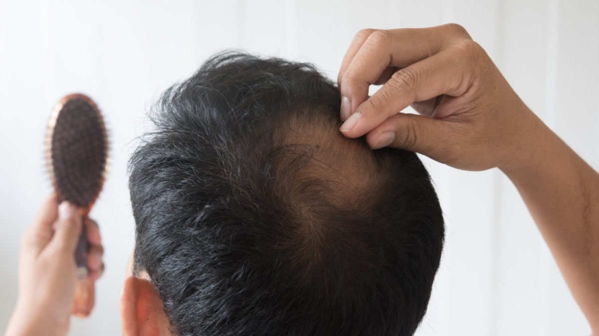 Erkeklerde saç dökülmesini durdurmanın 20 etkili yolu