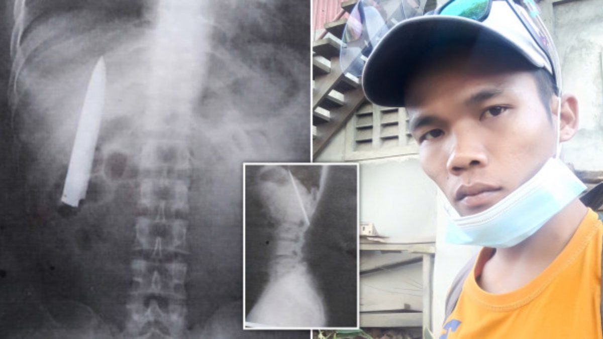 Filipinler'de vücudundaki bıçakla 15 ay yaşadı