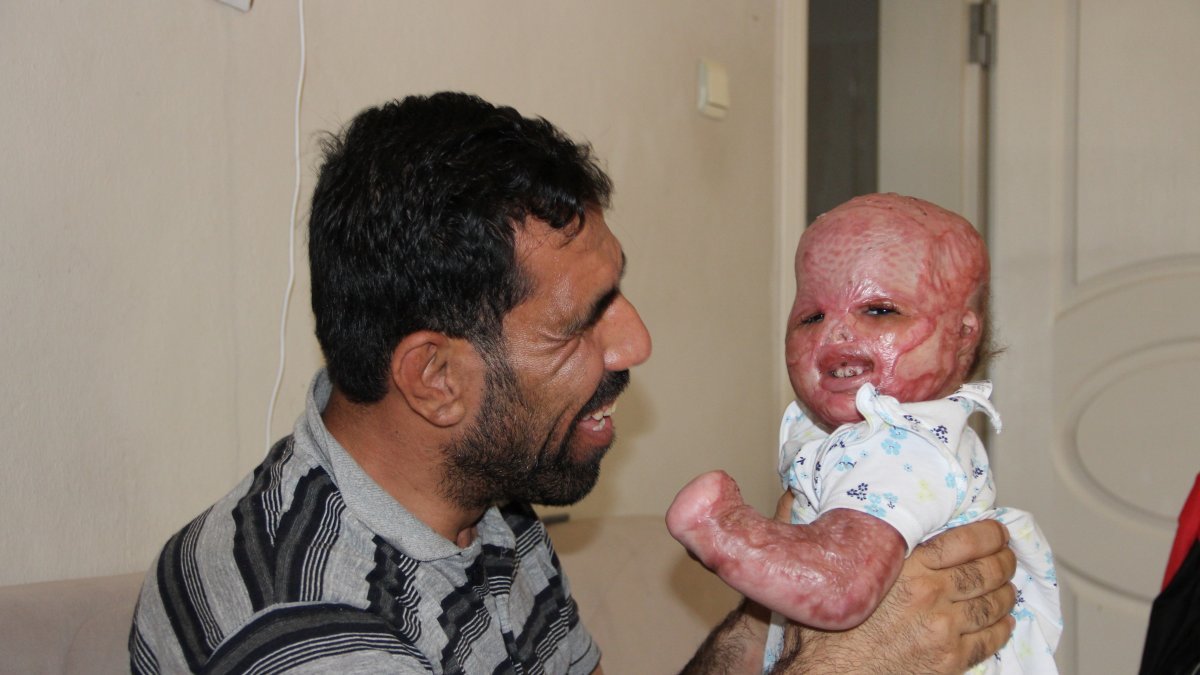 Suriyeli Delal bebek, yanıklarına rağmen hayata tutundu