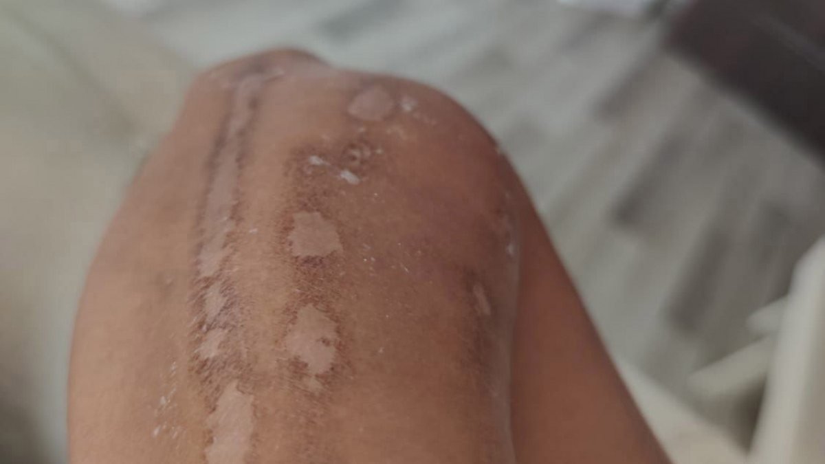 Diyarbakır'daki kadının, lazer yaptırırken kolu ve bacağı yandı