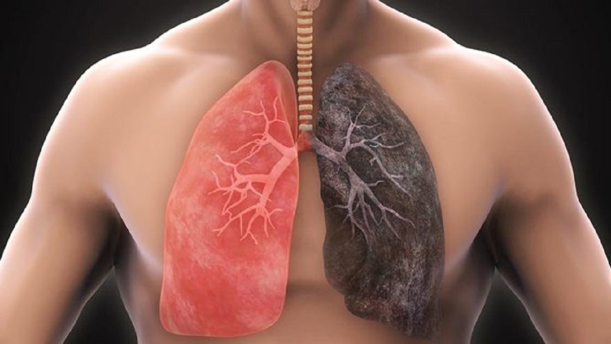 Koronavirüs, akciğer hastalarında uzun süren sorunlara neden oluyor