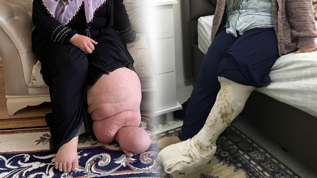 Muş'taki fil hastası, 21 yıl sonra ayakkabı giyme hayaline kavuşuyor