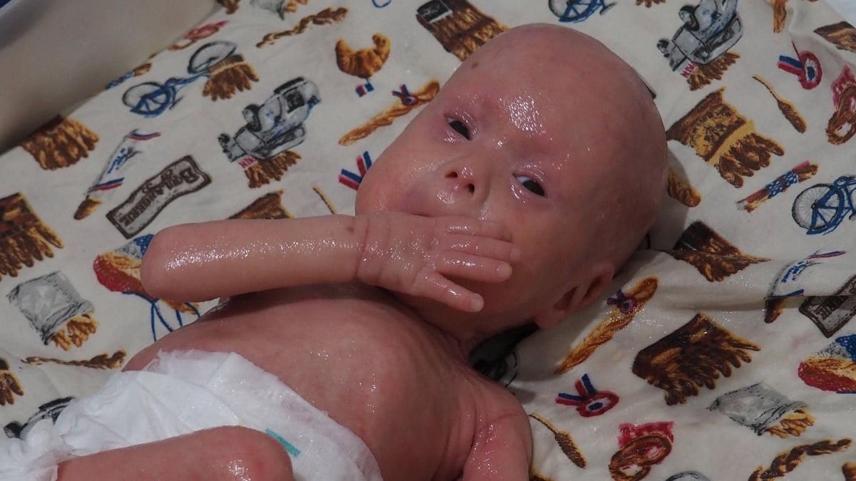 Palyaço Bebek Sendromu ile dünyaya gelen Gökdeniz 1 yaşında