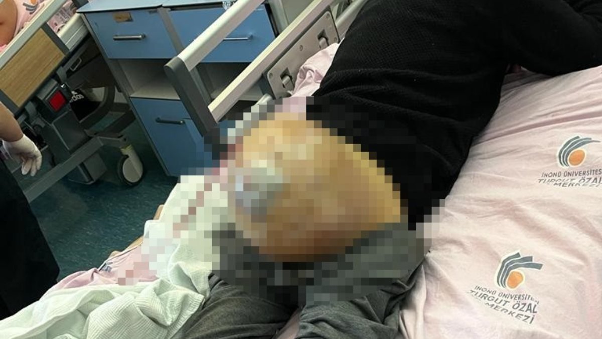 Şanlıurfa'da hastanın kalçasından 10 kilo tümör çıktı