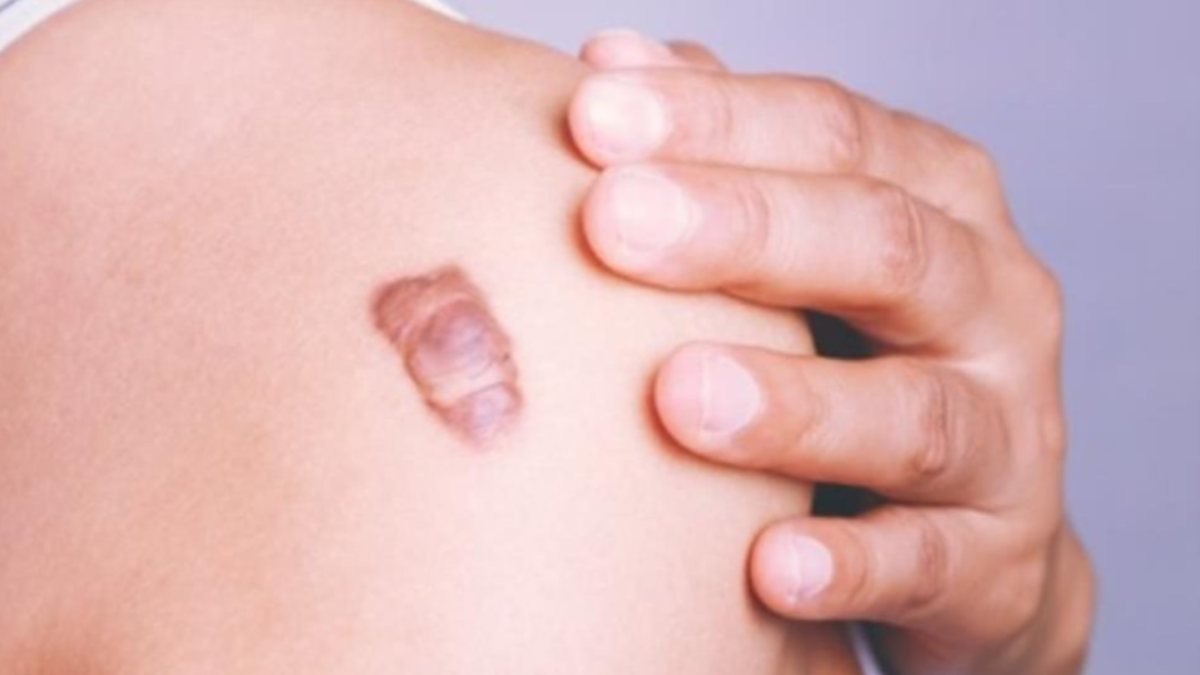 Keloid nedir