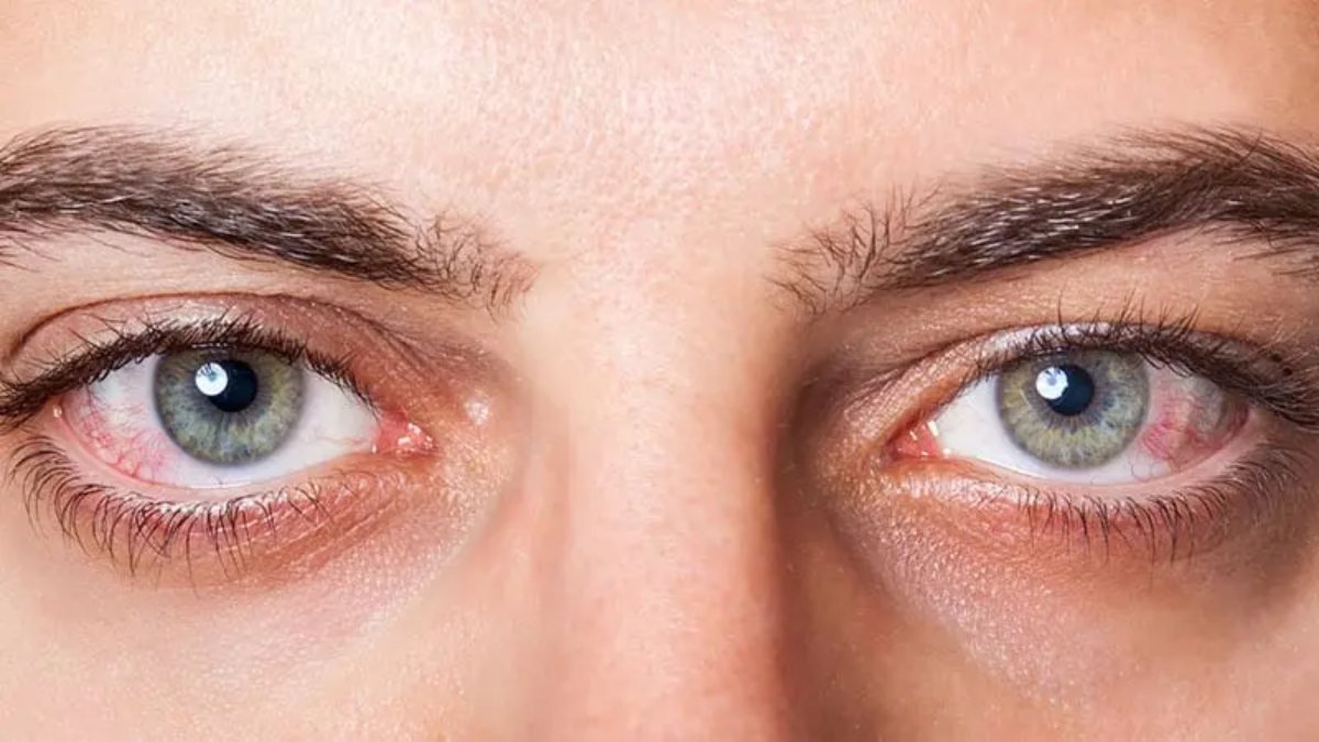 Göz tansiyonu ilerlemesine dikkat: Körlüğe neden olabilir