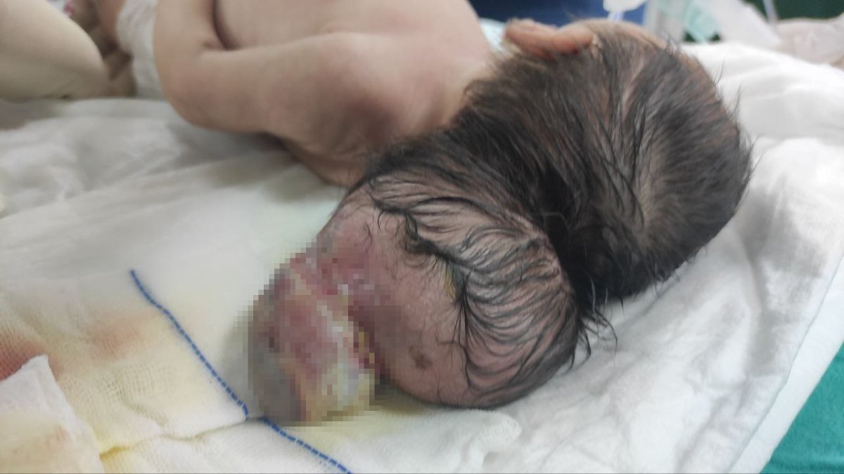 Kahramanmaraş’taki bebek beyninin yarısı kafatası dışında dünyaya geldi