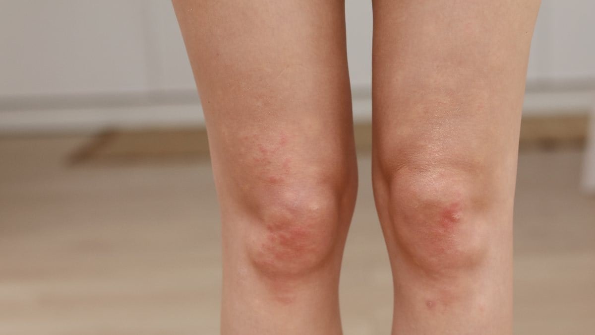 Bacaklardaki kırmızı noktaların en yaygın 10 nedeni