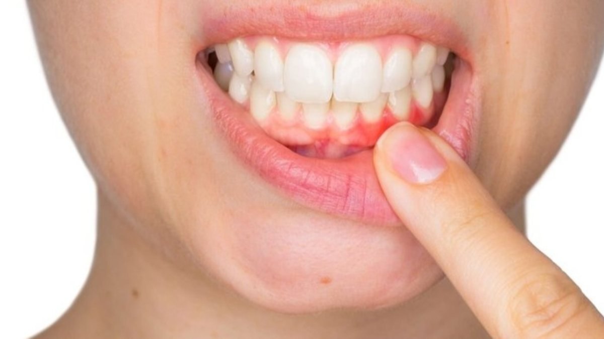 Diş eti iltihabına iyi gelen 3 mucizevi öneri