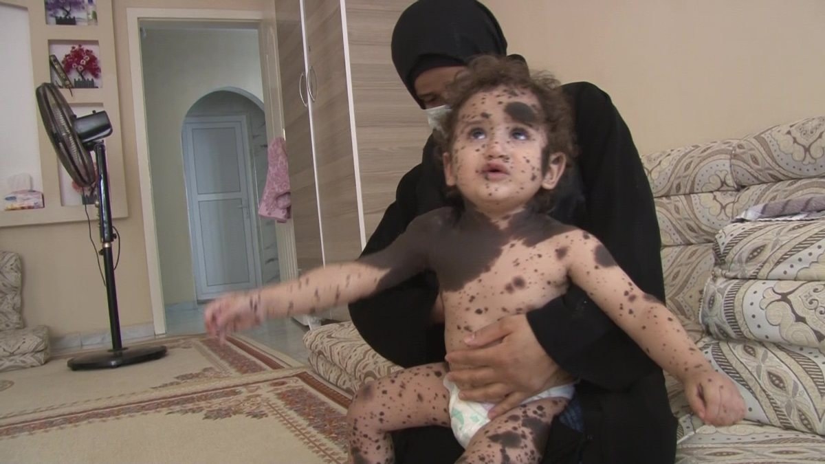 Hatay'da Suriyeli bebeğin hastalığına teşhis aranıyor