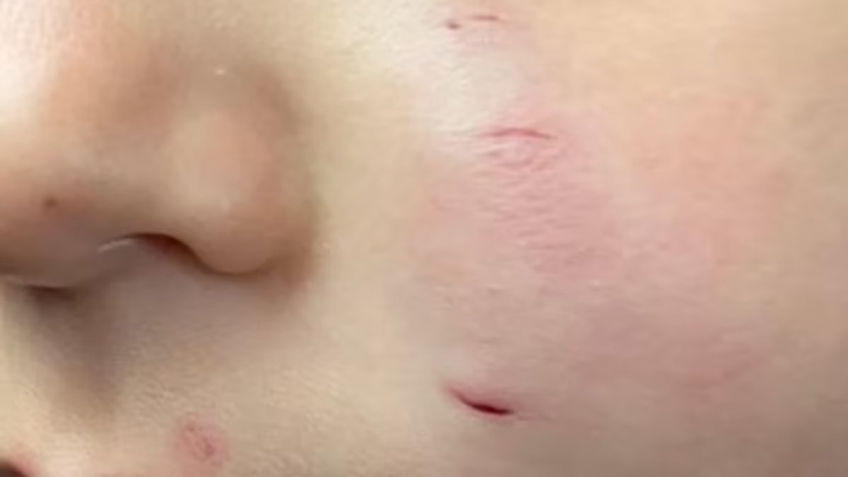 İngiltere'de 2 yaşındaki çocuğun yüzünü fare ısırdı