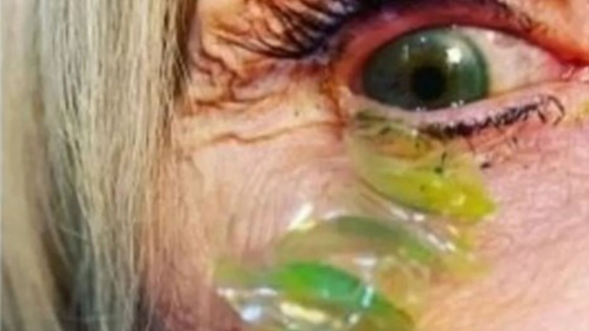 ABD’de, bir kadının gözünden 23 kontakt lens çıktı