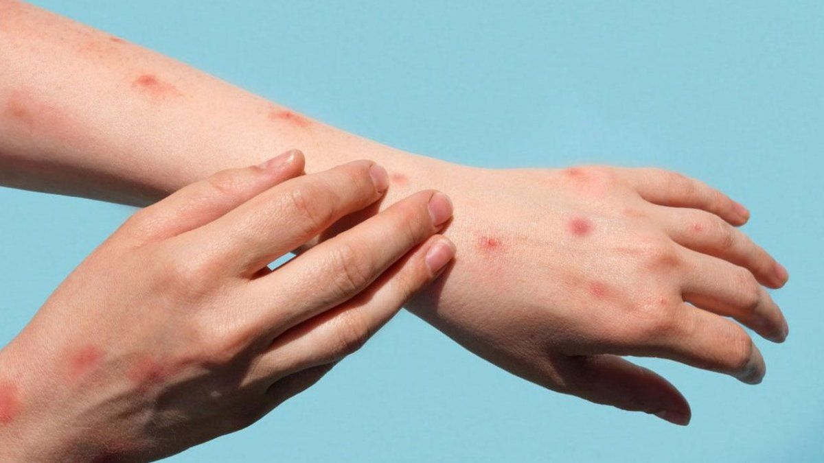 Dünya genelinde maymun çiçeği vakalarında son durum