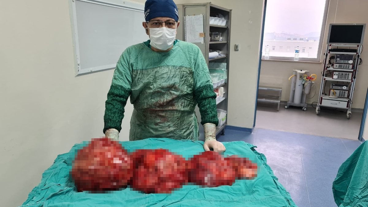 Tokat'ta, hastanın karnından 13 kilogram kitle çıktı