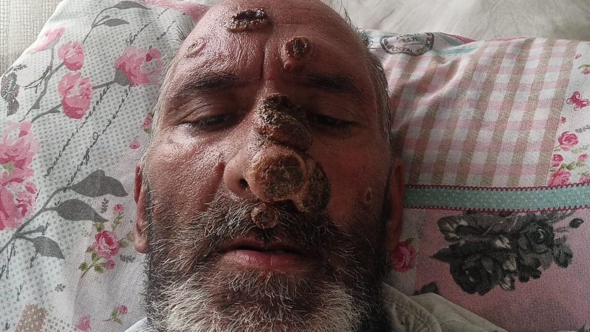 Antalya'da Afrika sineği ısıran adamın yüzünde yaralar çıktı