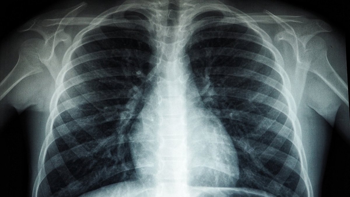 Vakalar patlıyor! Beyaz akciğer sendromu nedir, belirtileri nelerdir?