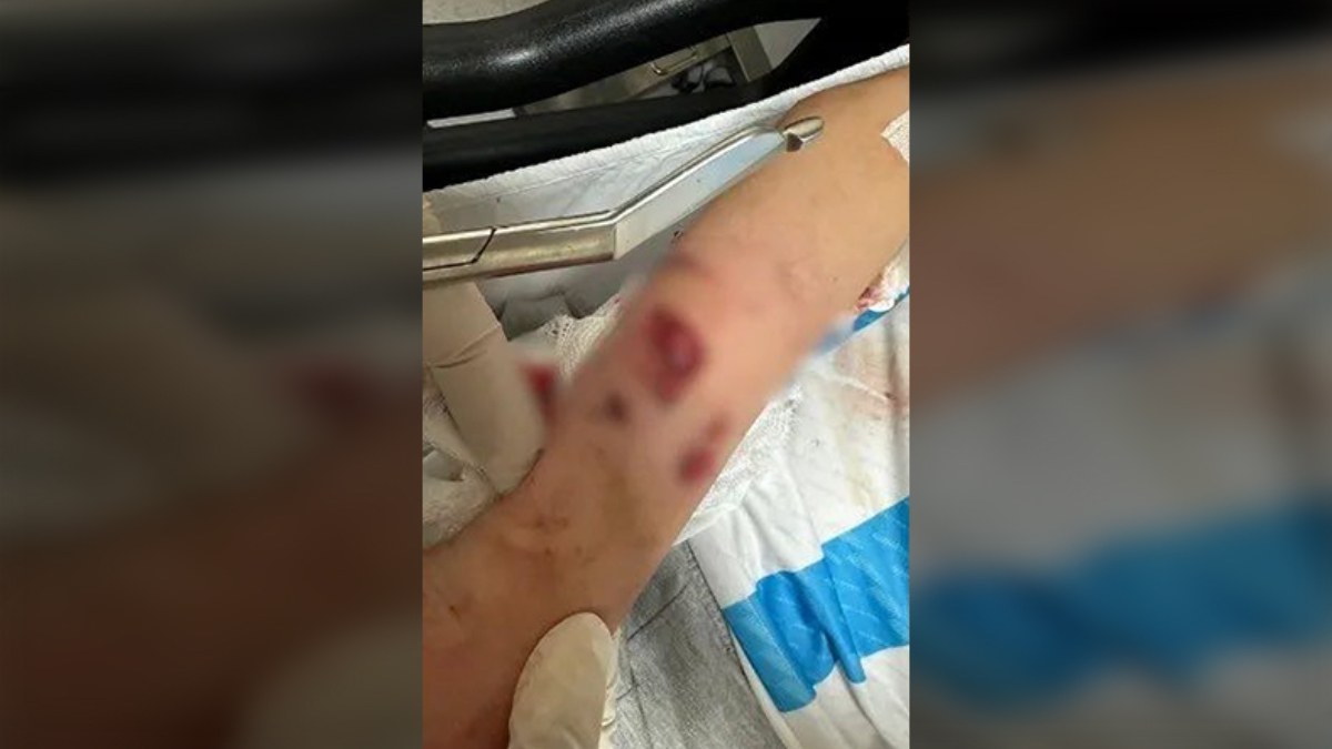 Rize'de sokak köpeklerinin saldırısına uğrayan çocuk yaralandı