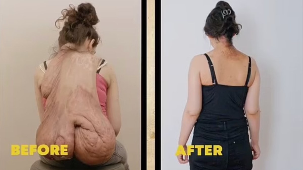 Almanya'da 20 kiloluk tümörle yıllarca yaşadı! Ameliyat hayatını değiştirdi