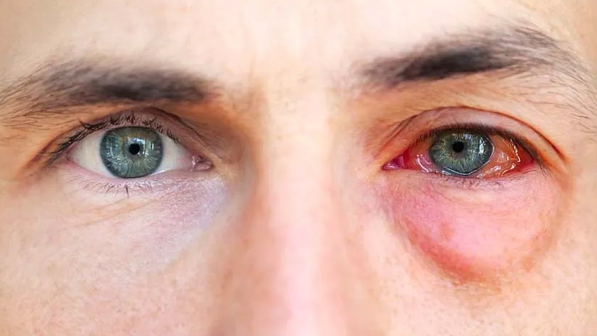 Baharın habercisi: Göz alerjisi belirtileri neler? Nasıl tedavi edilir?