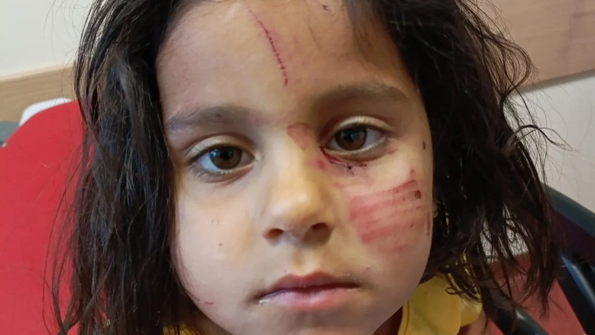 Şanlıurfa'da köpeklerin saldırdığı 4 yaşındaki Eylül yaralandı