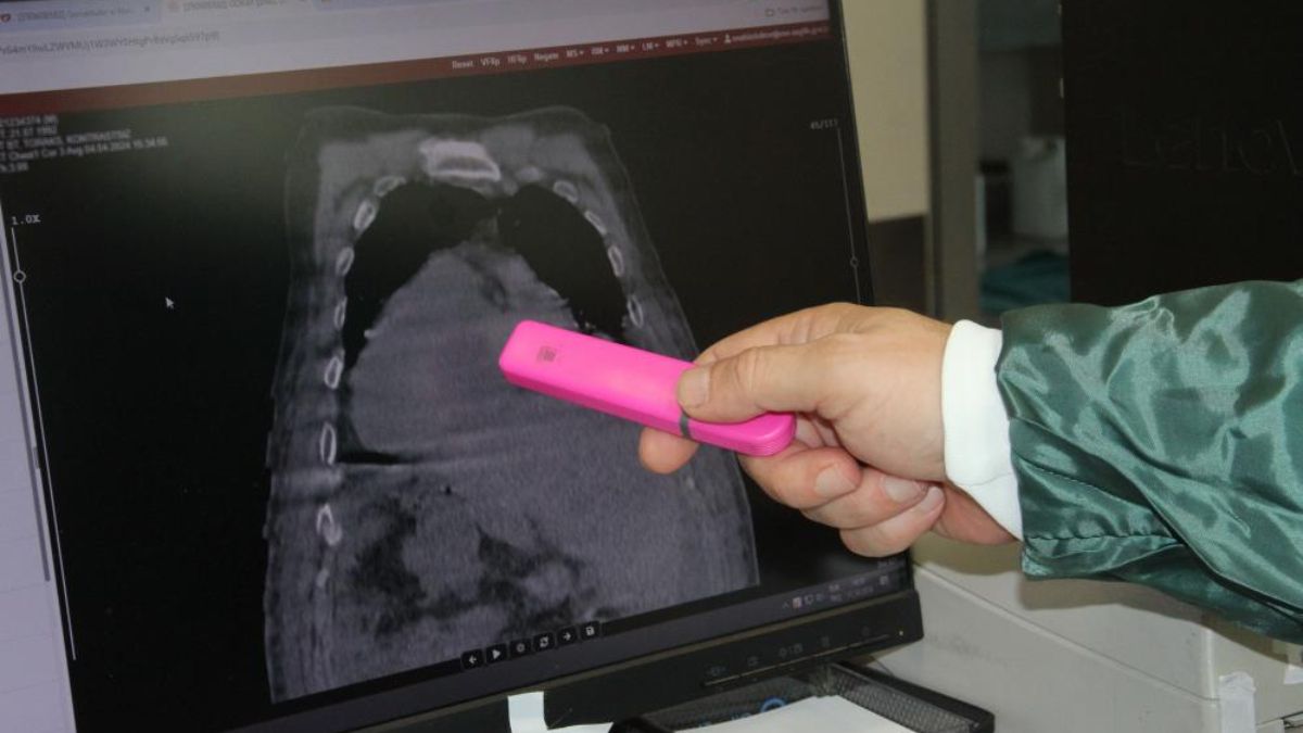 Giresun'dan tıp dünyasına katkı: Karadeniz Sendromu